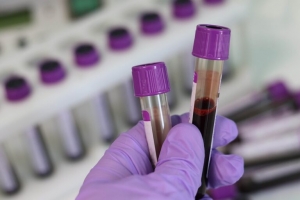 Εξέταση αίματος τεχνητής νοημοσύνης εντοπίζει γρήγορα δύσκολα ανιχνεύσιμους καρκίνους
